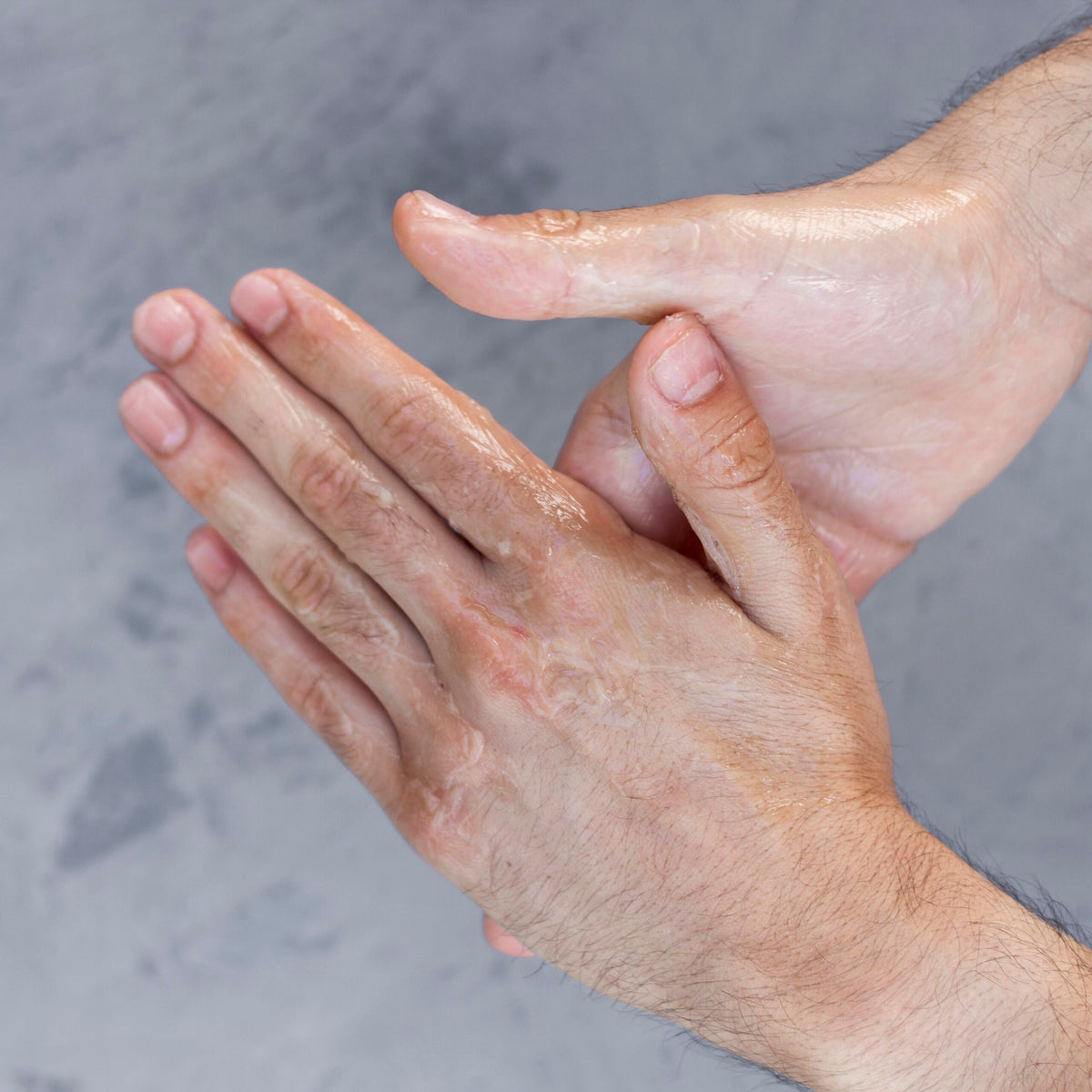 Hiperhidrosis palmar, síntomas y tratamiento