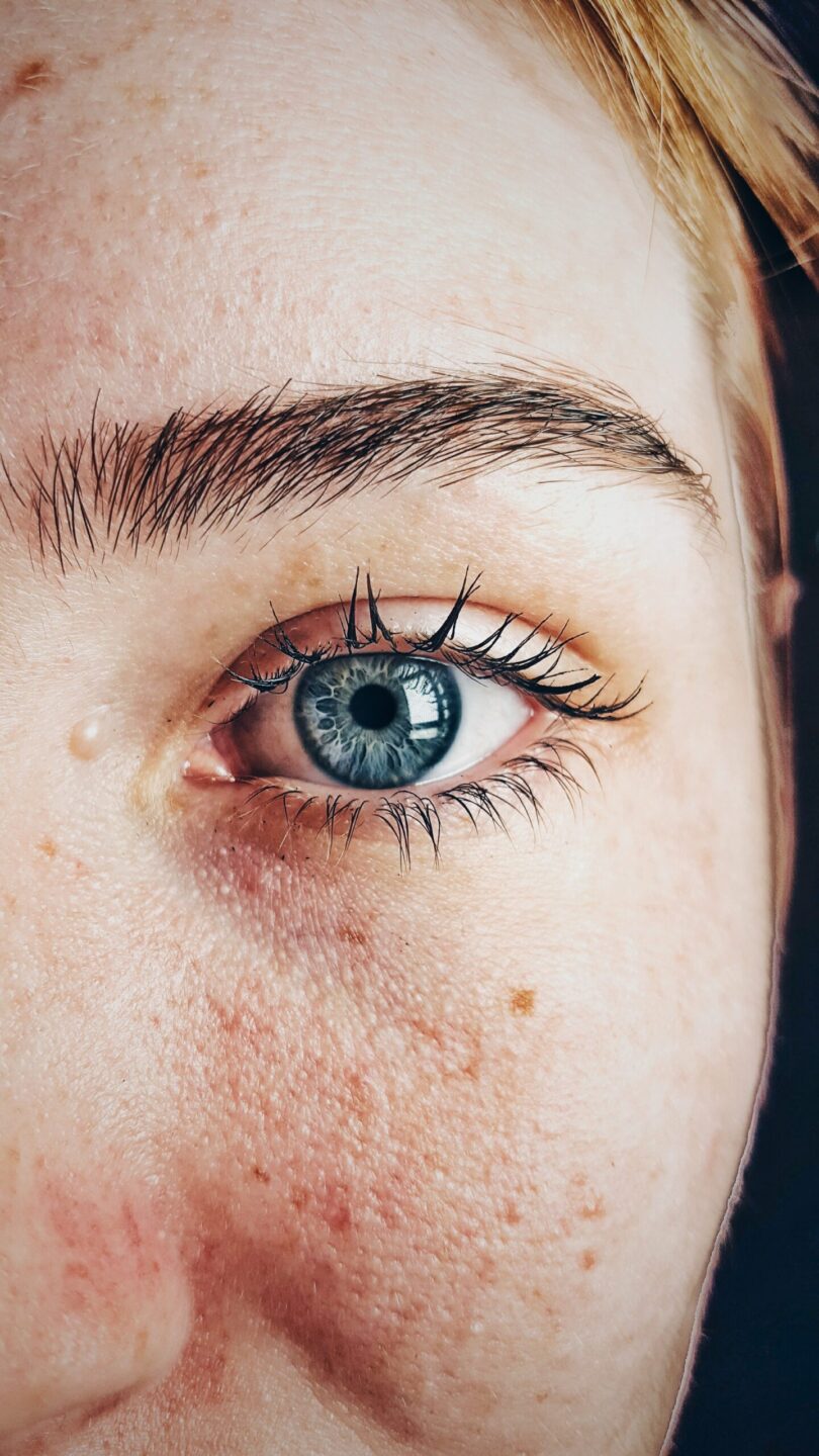 Dermatitis de contacto