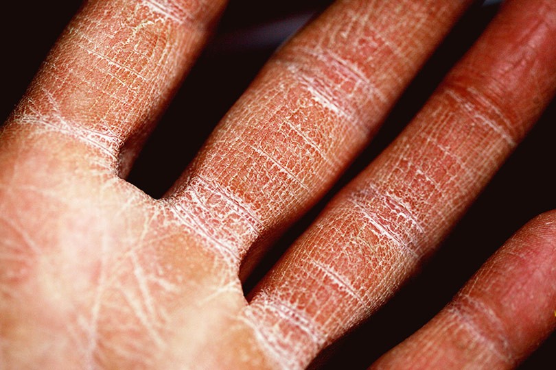 ¿Por qué tengo dermatitis atópica?